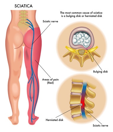 Sciatica Pain  Omni Physical Therapy & Wellness