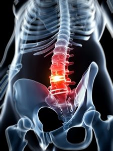 Physical Therapy for Bulging Discs