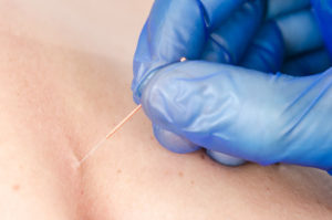 Dry Needling Frequently Asked Questions