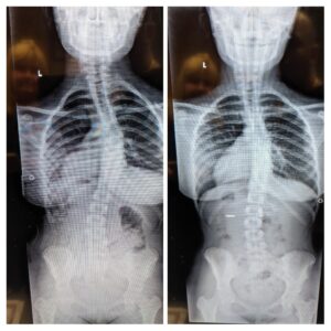 Scoliosis Curve reduction in 6 months of Schroth Method for Scoliosis