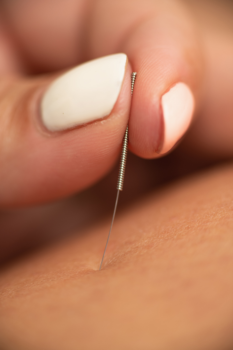 Dry Needling Side Effects