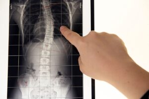 Scoliosis Xray